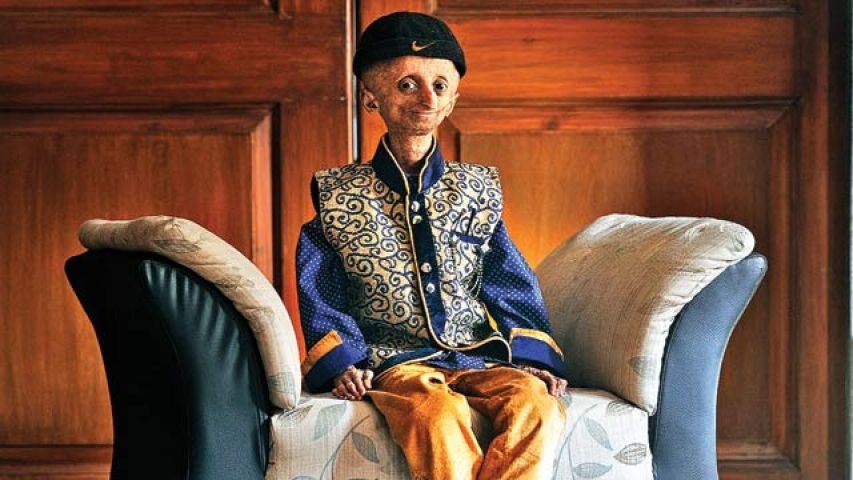 Nihal a mumbai only child suffering progeria passes away