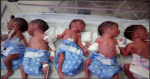 Pre-mature Quintuplets born in Chhattisgarh