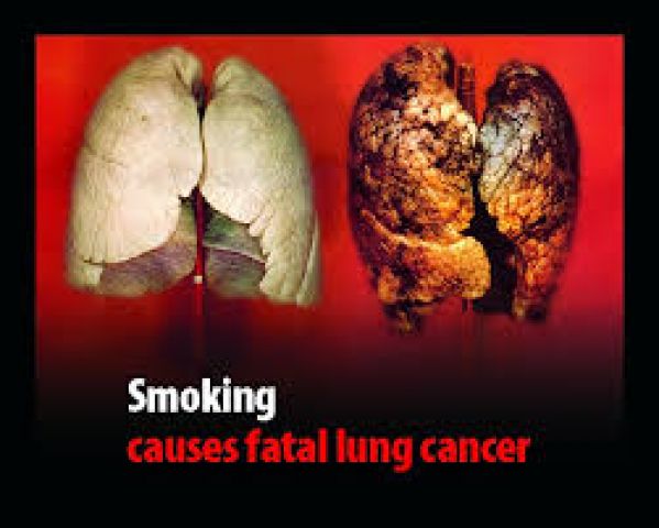 ‘Bad lifestyle behind 80pc of lung cancer cases among old’