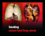 ‘Bad lifestyle behind 80pc of lung cancer cases among old’