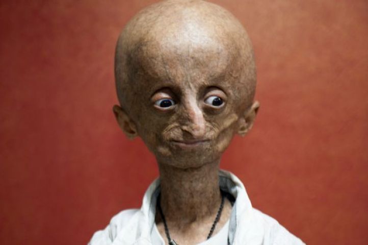 Nihal Bitla, who suffered from ultra-rare genetic disorder progeria, has died