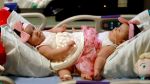 Texas -Conjoined twins share a colon and bladders that will be reconstructed