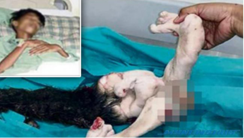 15 year old lived with unborn twin inside him for 15 years