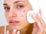 See the magic of herbal leaves on pimples!