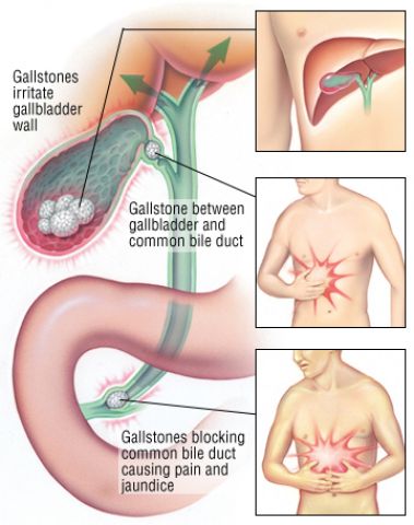 Natural home remedies for Gallstones!!!