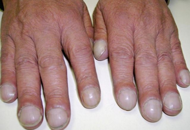 What your nail says about your health!!!