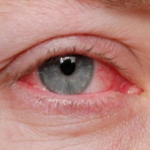 How to treat pink eye at home!!!