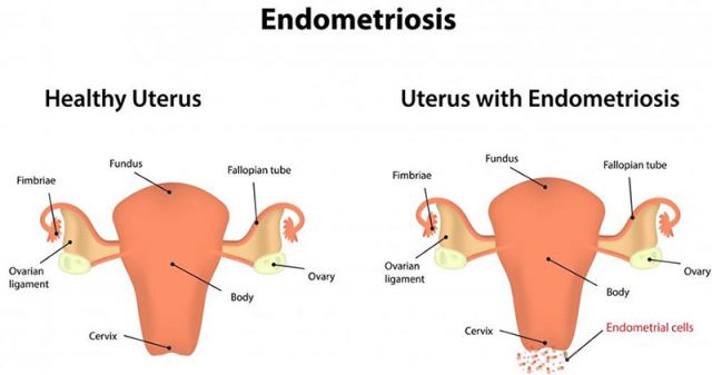 Endometriosis – Here’s how you can treat it!!!