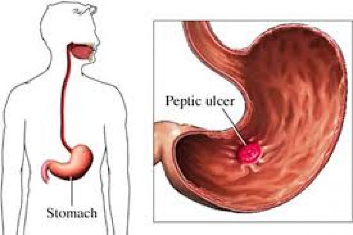 Ever heard of Peptic Ulcers???