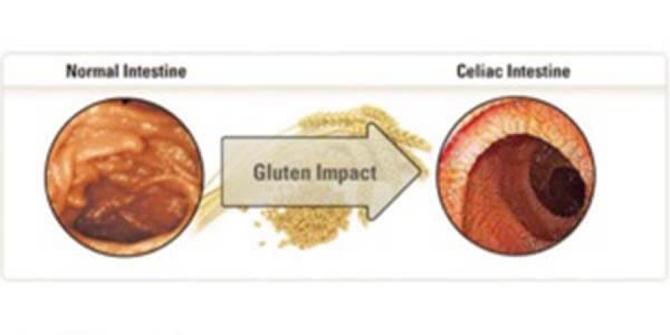 The facts about CELIAC DISEASE!!!