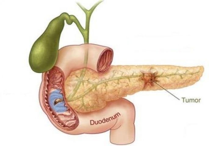 How can 'Bile Duct' cancer be treated ?