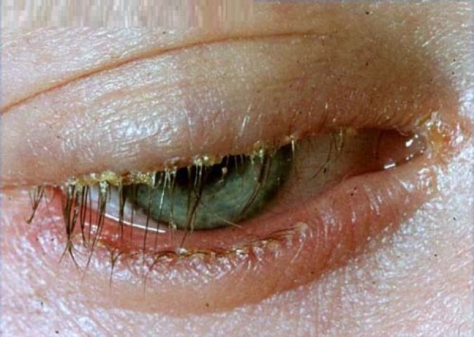 Are you have an eyelid inflammation? It could be Blepharitis