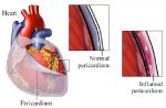 Pericarditis - Do you know what it is?