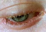 Are you have an eyelid inflammation? It could be Blepharitis