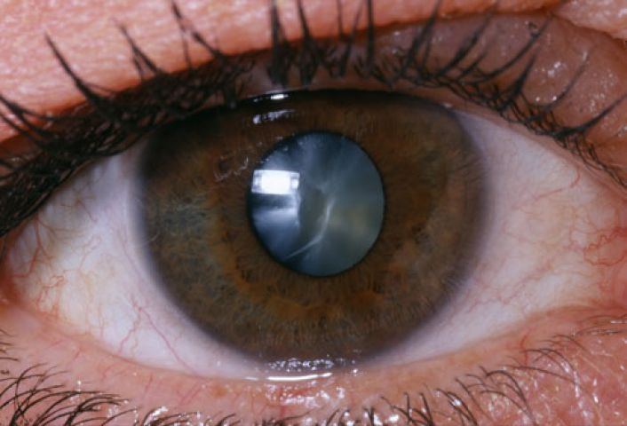 Cataract - You could have it too!