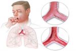 Fight 'Bronchitis' with these simple tips !