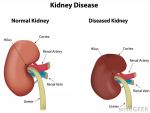 What you need to know about 'Chronic Kidney Disease'