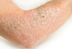 Tips for treating 'Psoriasis'!!!