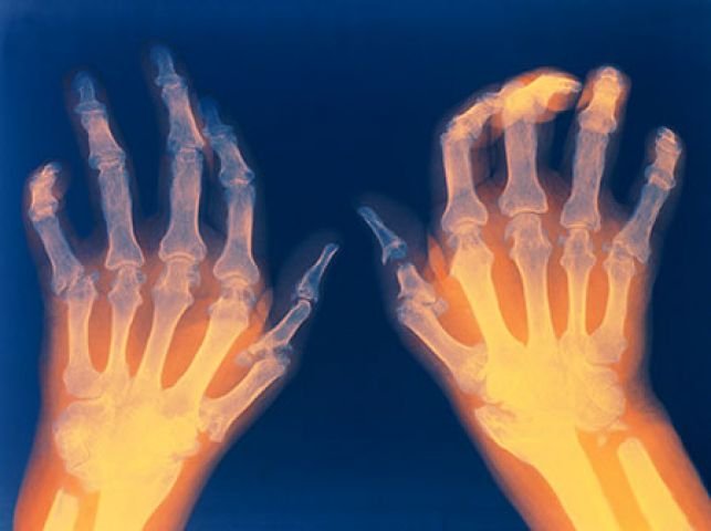Suffering from Arthritis? Try these natural remedies!!!