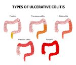 Tips for coping with 'Ulcerative Colitis'