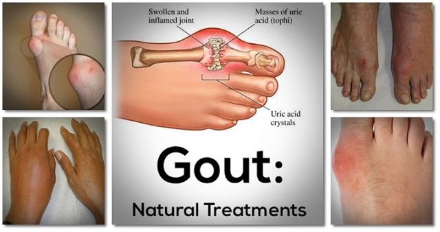 Say Goodbye to Gout Forever with this Natural Remedy!!!