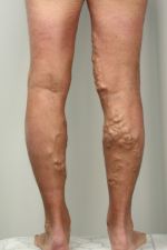 Try out these natural remedies to treat your Varicose Veins!!!