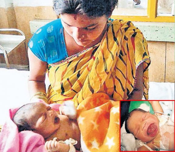 जबलपुर में हुआ दुनिया का जटिल ऑपरेशन, डॉक्टरों ने लौटाई माँ की मुस्कान