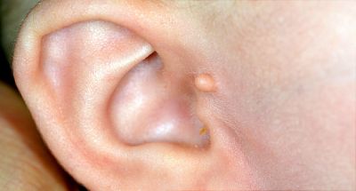 कान के इंफेक्शन से राहत पाने के लिए करें ये उपाय