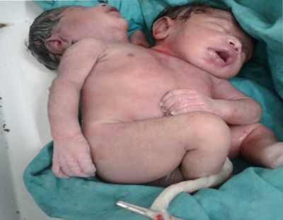महिला ने दिया अनोखे बच्चे को जन्म, देखकर डॉक्टर के रोंगटे खड़े हो गए
