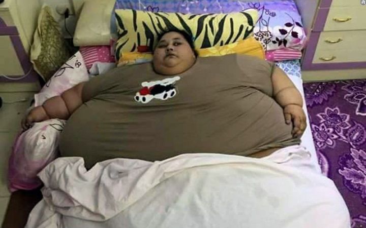 सबसे मोटी महिला की हुई सर्जरी, कम हुआ 100 किलो वजन