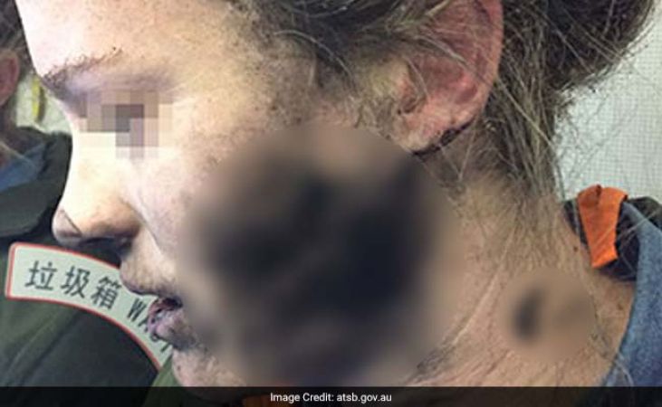 हवाई सफर के दौरान  हेडफोन की बैटरी फटने से  महिला झुलसी