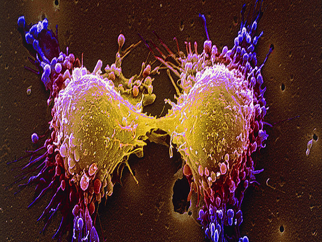 ज्ञान -विज्ञान : कैंसर सेल्स को समाप्त करने की नई विधि