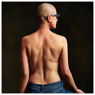 वर्ल्ड कैंसर डे पर आयुष्मान की पत्नी हुई टॉपलेस, दिखाया सर्जरी मार्क