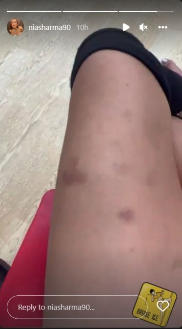 Nia Sharma bruises her leg while practicing for her dance performance