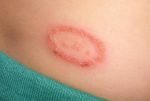 Adopt this home remedy if you are troubled with ringworm