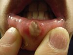 मुँह के छालों का घरेलु इलाज