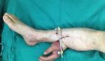 Extraordinary operation;Man’s Severed hand grafted to his leg for a Month