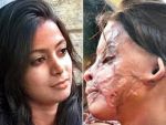 Acid Attack victim Manisha still awaits for the Justice!!