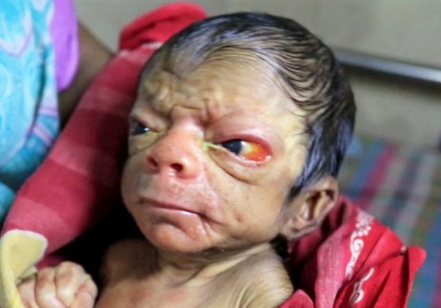 New Born Baby in Bangladesh looks like an 'Old Man'!!