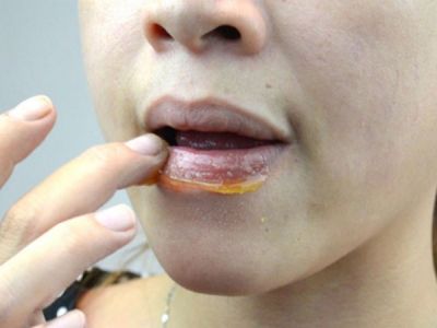 होंठो को फटने से बचाता है ग्लिसरीन और शहद