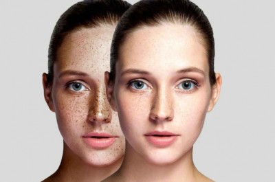How to Remove Facial Freckles: A Comprehensive Guide