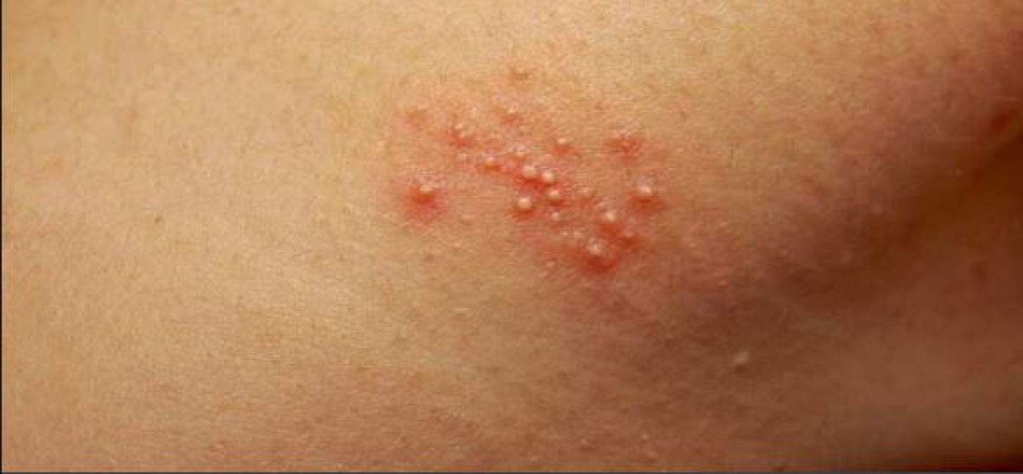 If you are disturbed by heat rashes, then try these home remedies for instant relief