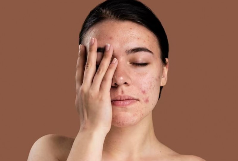 How to Prevent Skin Peeling Even in Summer?