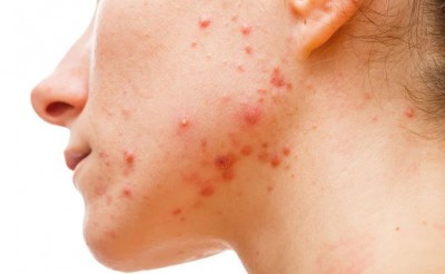 Why Do You Have Acne on Your Face? Understanding the Causes