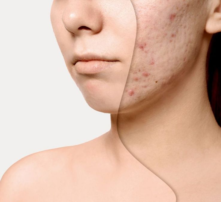 Want to get rid of pimples? Then do this treatment
