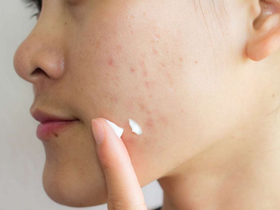 Want to get rid of pimples? Then do this treatment