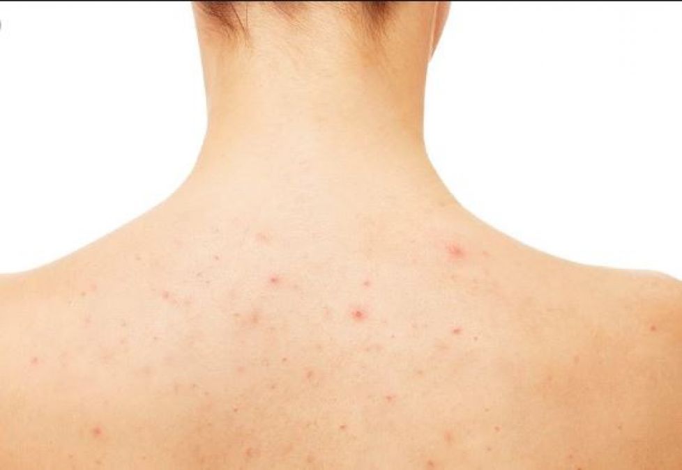 Get Rid of Back Acne with These Tips
