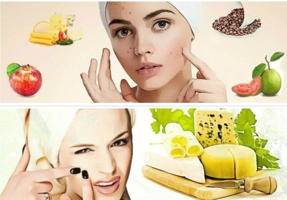 How to prevent pimples: 5 Natural Ways to Get Rid of Pimples as Fast as Possible