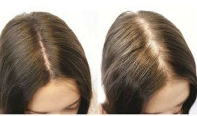 Simple & Effective Home Remedies to Control Hair Fall