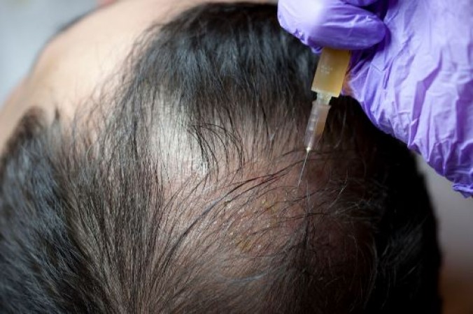 What Is PRP Treatment and How Can It Stop Hair Fall?